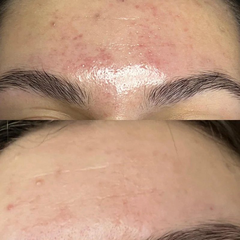 Acne op het voorhoofd, voor en na
